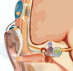 図5　人工内耳の仕組み