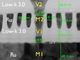 CMOS多層配線の高密度化を支えるビア電極の微細化