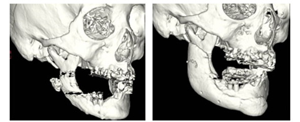 世界初 3dプリンタで人工骨を成形 薬事承認申請 時間経過で自骨に変化 医療機器ニュース Monoist