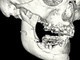 「世界初」3Dプリンタで人工骨を成形、薬事承認申請