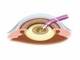 眼内圧の変動をモニタリングするシステム、白内障手術のリスクを低減
