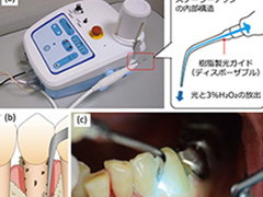 重度の歯周病に効果的な殺菌法 東北大学が早期の臨床導入を目指す 医療機器ニュース Monoist