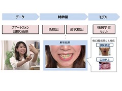 スマートフォンを活用した歯周病発見aiの共同研究を開始 Monoist