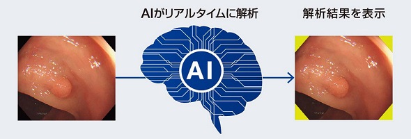 Aiで大腸内視鏡画像を解析する 内視鏡画像診断支援ソフトウェアを発売 Monoist