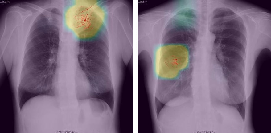 深層学習技術を用いたX線画像診断補助ツールを肺がん検診に導入