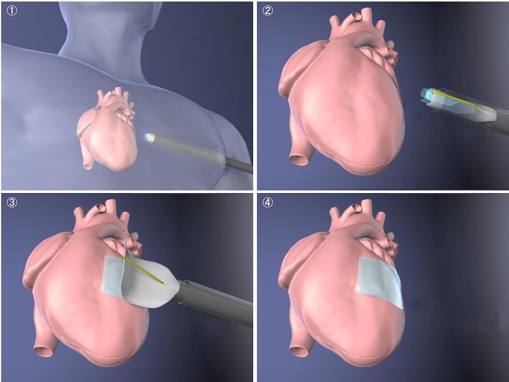 小さな切開で細胞シートを心臓に移植できるデバイスを開発