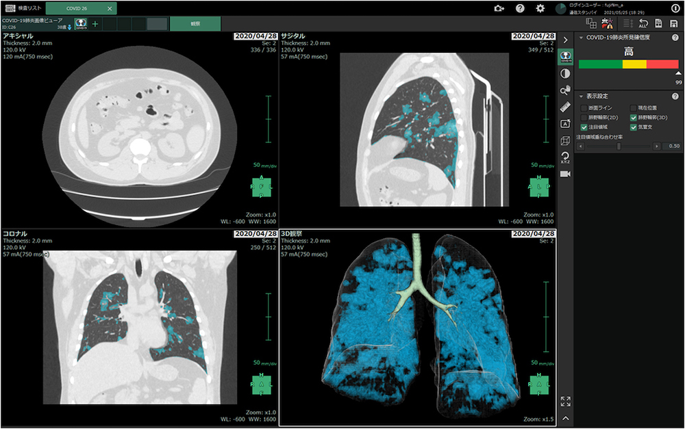 新型コロナウイルス肺炎の画像診断を支援するソフトウェアを発売