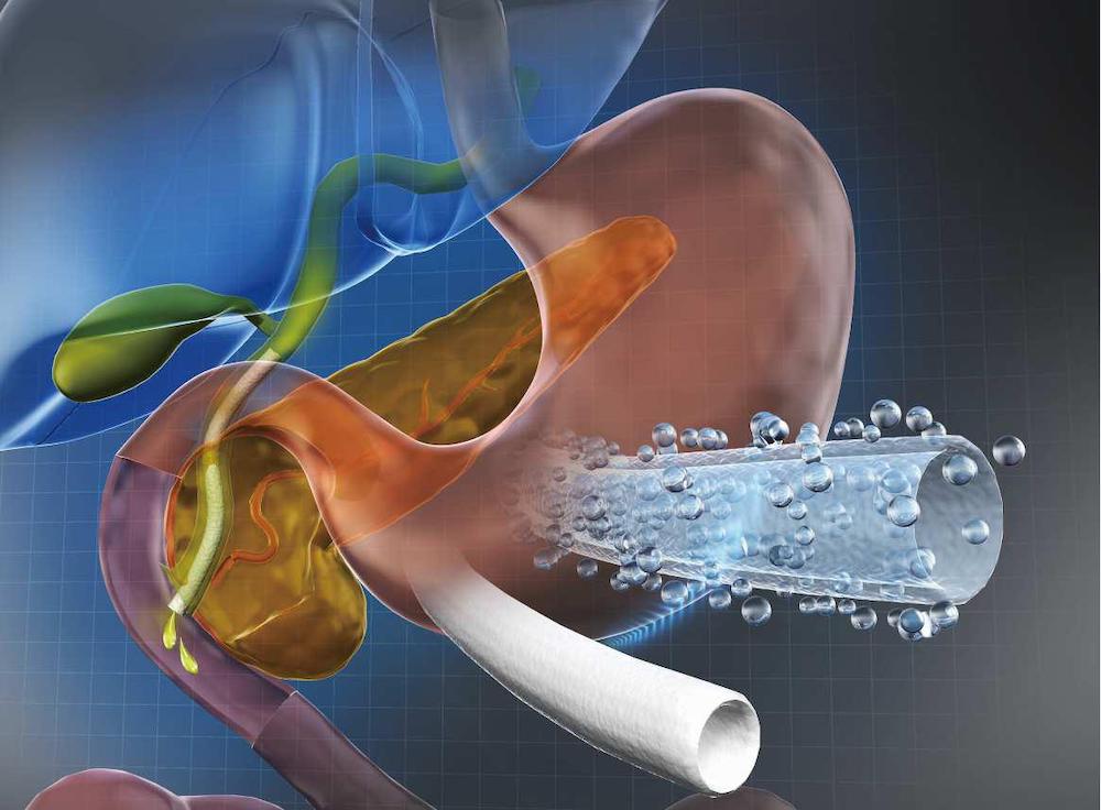 抜去可能で長期間利用できる胆管用ステントを開発、がんの緩和療法適用に期待：医療機器ニュース - MONOist