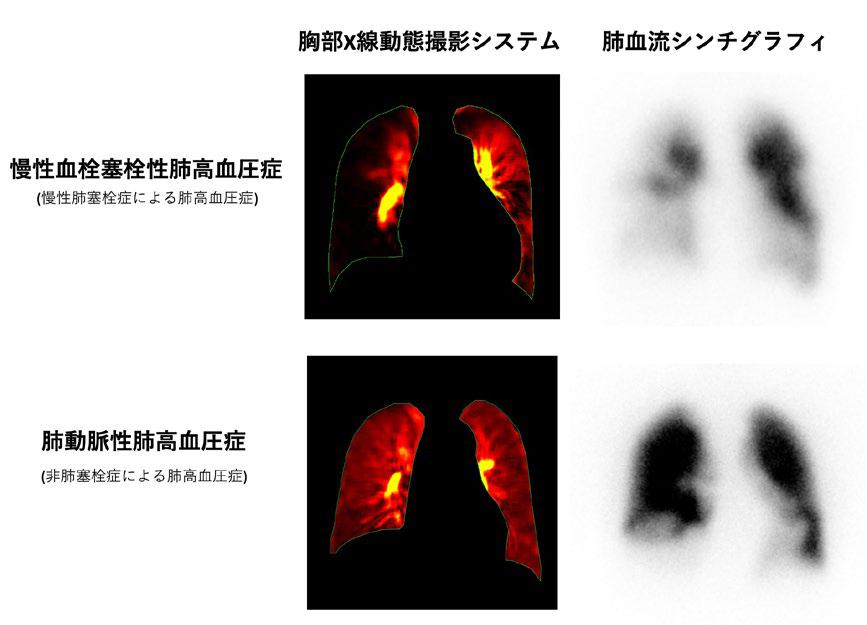 CT は PE の診断にどのように使用されますか?