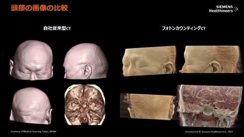 従来型CT（左）とフォトンカウンティングCT（右）の頭部画像の比較
