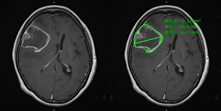 希少がんである神経膠腫の画像評価精度を向上させるAI技術を開発