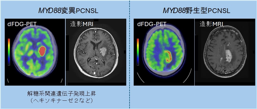 MYD88変異を可視化、脳リンパ腫に新たな画像診断技術：医療技術