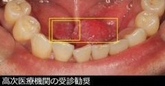 Mucosight AI 約 30 秒篩查疑似口腔癌