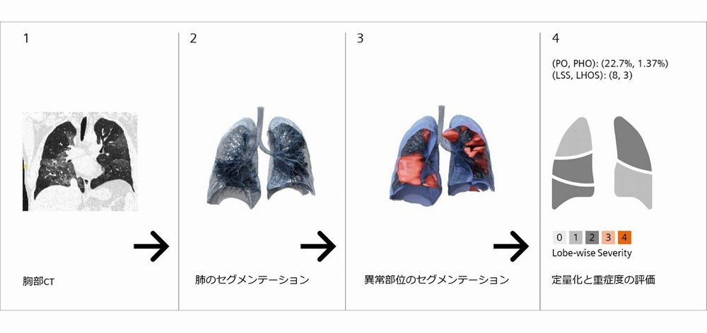 Aiが肺のct画像から異常を検出 新型コロナ解析の一助に 臨床研究用ソフト登場 Itmedia News