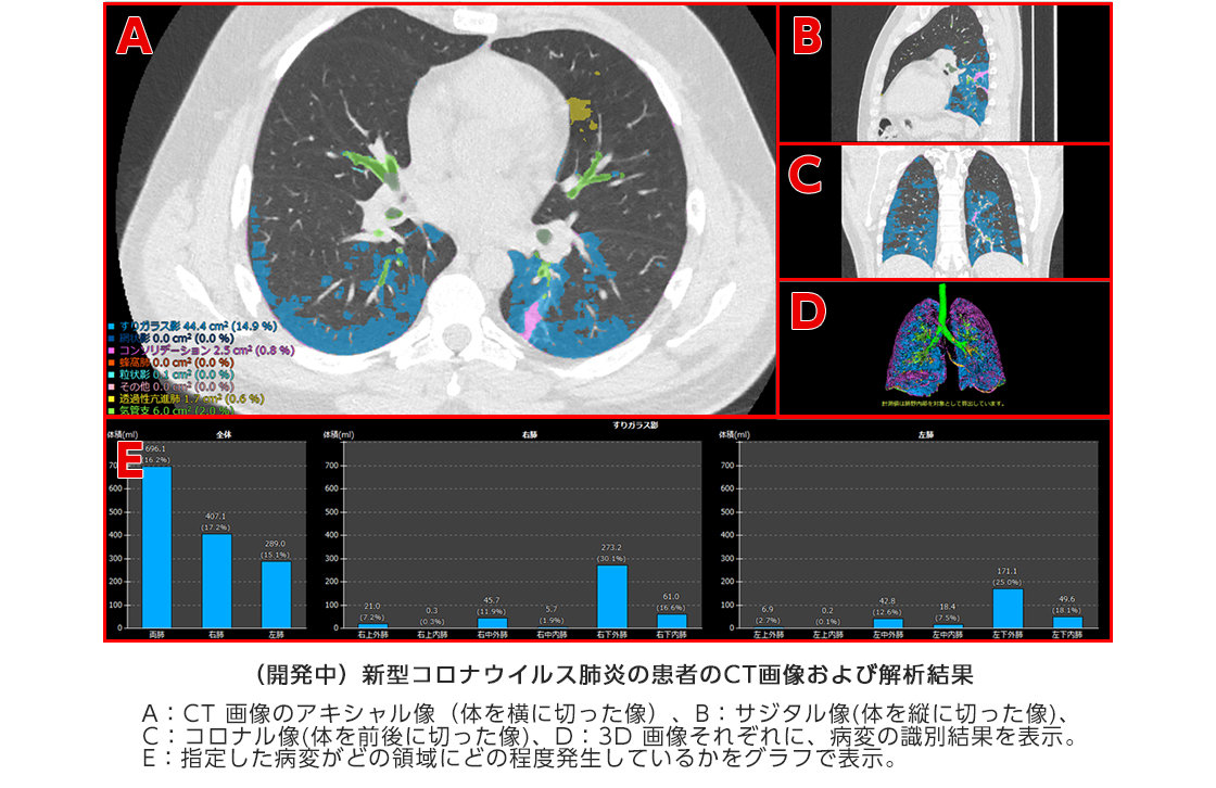 富士フイルム 新型コロナ肺炎の診断サポートai開発へ Ct画像を自動解析 Itmedia News