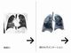 AIが肺のCT画像から異常を検出、新型コロナ解析の一助に　臨床研究用ソフト登場