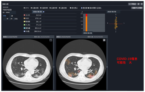 富士通 胸部ct画像から新型コロナ見抜くai開発へ Itmedia News