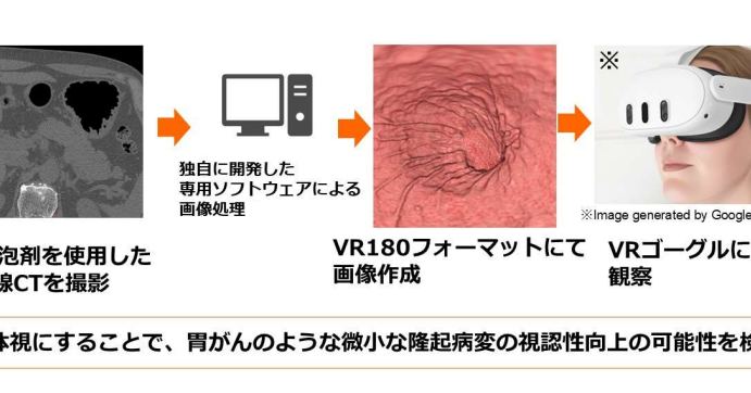 èã«ã¡ã©ãããªãŠã ã䜿ããªããèã®æ°ããæ€æ»æ³ãååžå€§ãšé沢倧ãéçºãçºæ³¡å€ïŒCTæ®åœ±ã§å
éšãç«äœèгå¯