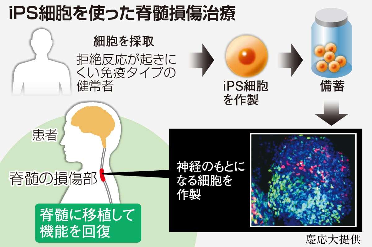 慶大のiPS脊髄損傷治療、最長4年追跡で長期的な安全性確認 来年度中に