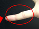 「スマホの使いすぎで小指が変形＝テキストサム損傷」は誤用？　いつから誤解が広まったのか調べてみた