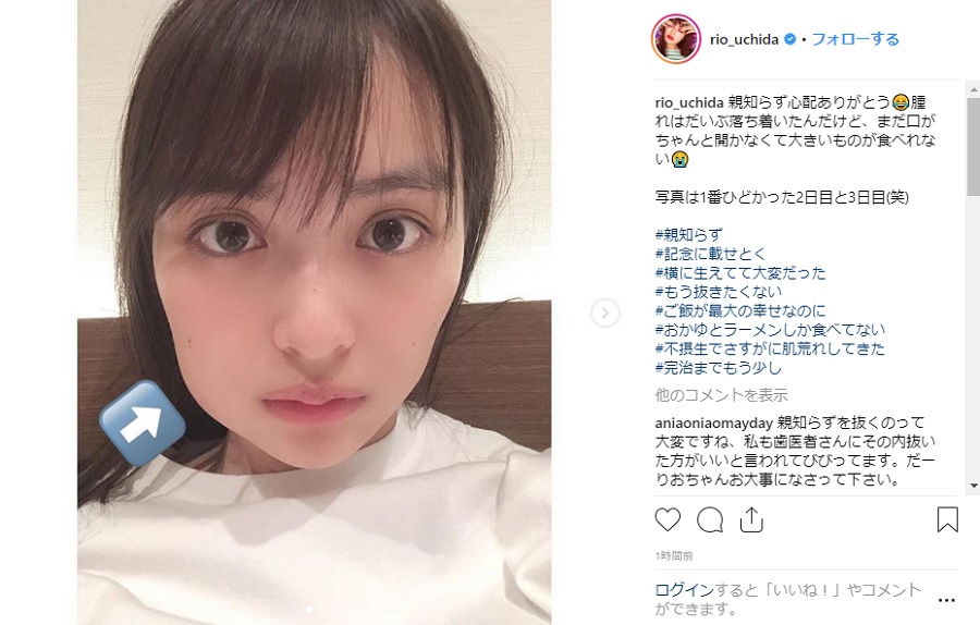 痛々しいけどカワイイ 内田理央 親知らずを抜いた右頬ぷっくり写真にファンが新たな魅力を見いだす ねとらぼ