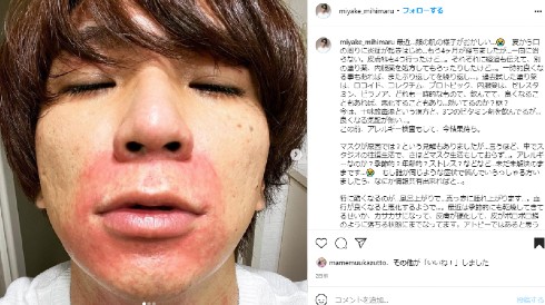 Mihimaru Gt Miyake 炎症で顔が真っ赤 皮膚科を複数受診も 皮膚が硬化して 皮がポロポロ鱗のように 1 2 ページ ねとらぼ