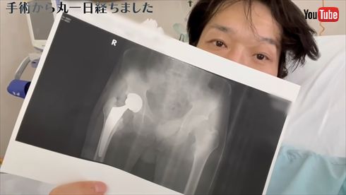 「特発性大腿骨頭壊死症」の手術成功を告げる千原ジュニア