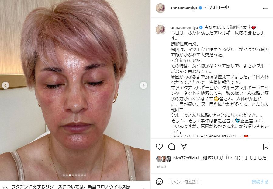 梅宮アンナ、接触性皮膚炎の原因は“まつげエクステの接着剤” ひどい腫れも「毎回症状は、出ないから厄介」 (l_annasick