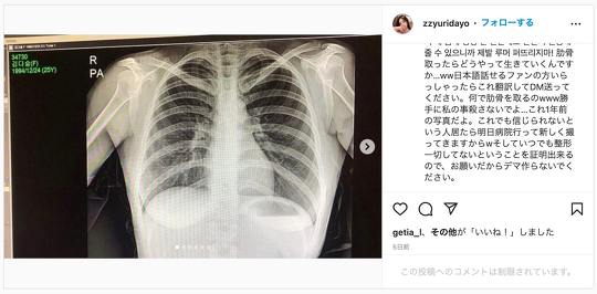 「韓国の肋骨取る手術やりたい…韓国のウエスト細い人ほぼやってる」というツイートが波紋