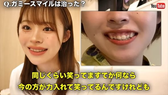 「こんなに変わるの 」「めっちゃ綺麗！」 人気youtuber、3年間の“歯列矯正ビフォーアフター”で垢抜け美女に大変身（2 2 ページ